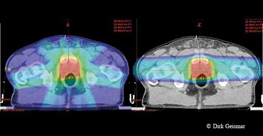 Die Strahlungsverteilung im Vergleich: links eine perkutane Strahlentherapie mit Photonen (IMRT), rechts die Bestrahlung mit Protonen (IMPT), die eine deutlich geringere Belastung des umgebenden Gewebes aufzeigt.