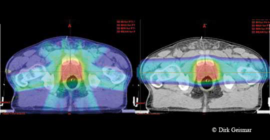 Protonenbehandlung von Prostatapatienten - Interview mit Dr. Dirk Geismar - Titelbild