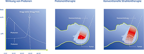 Schaubild zum Tiefendosisverlaufs mit Protonen und Photonen.