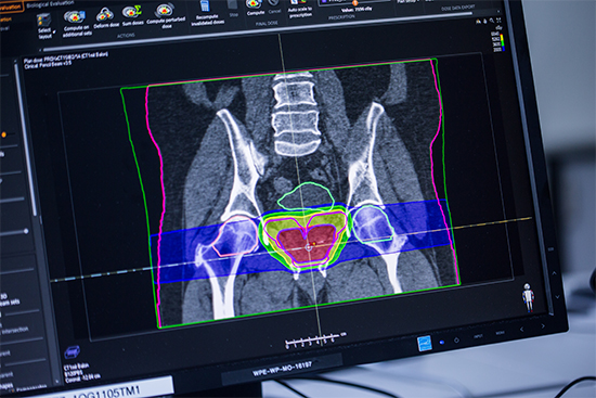Bei der Bestrahlungsplanung wird zu schonendes Gewebe wie z.B. die Blase oder der Darm berücksichtigt, damit der Protonenstrahl diese Bereiche nach Möglichkeit nicht durchdringt.