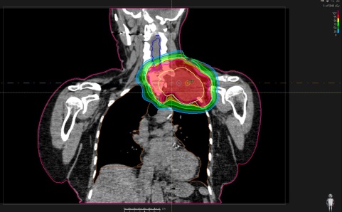 Neu im WPE: PROTONENTHERAPIE MIT DOUBLE SCATTERING - Titelbild