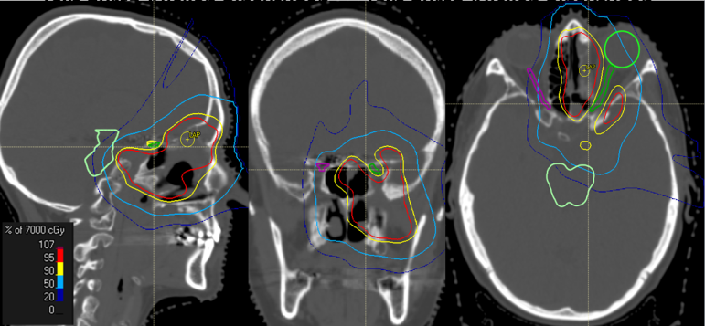 Dosisverteilung von Protonen bei Tumor der Nasennebenhöhlen.