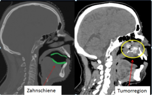 Zahnschiene bei einem Patienten mit einem Tumor im Bereich der Kieferhöhle.