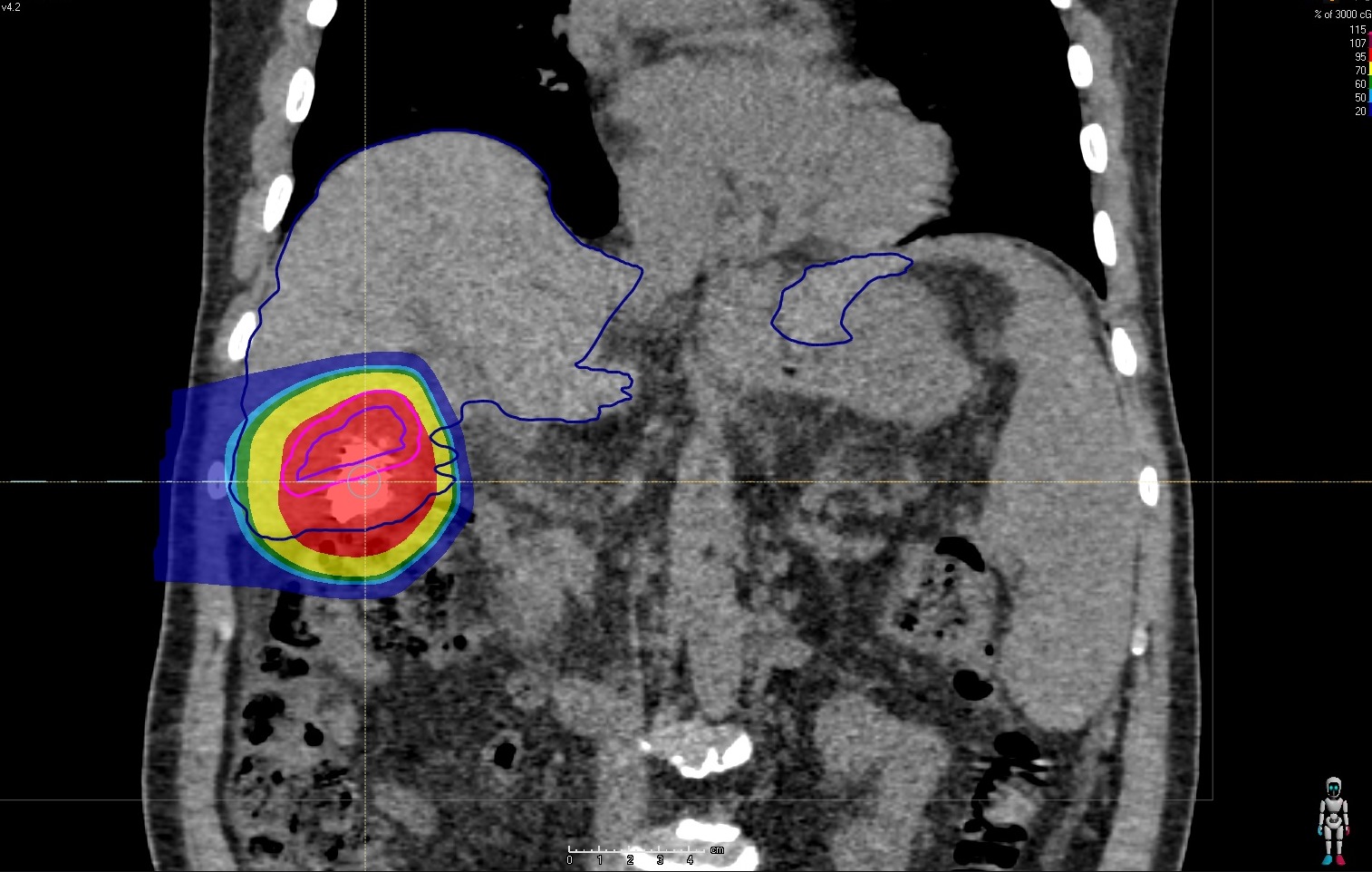 Bessere Heilungschancen, bessere Lebensqualität: Protonentherapie bei hepatozellulären Karzinomen - Titelbild