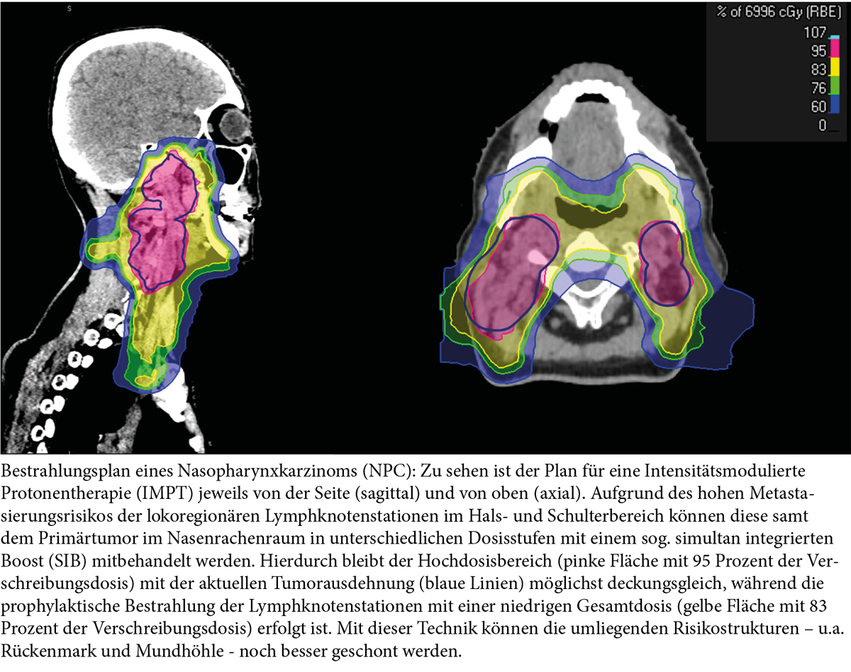 Die Chancen liegen im Detail: Protonentherapie bei Kopf-Hals- und Schädelbasistumoren - Titelbild