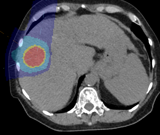 Pilotstudie zur intensitätsmodulierten, hypofraktionierten Radiotherapie mit Protonen für HCC - Titelbild