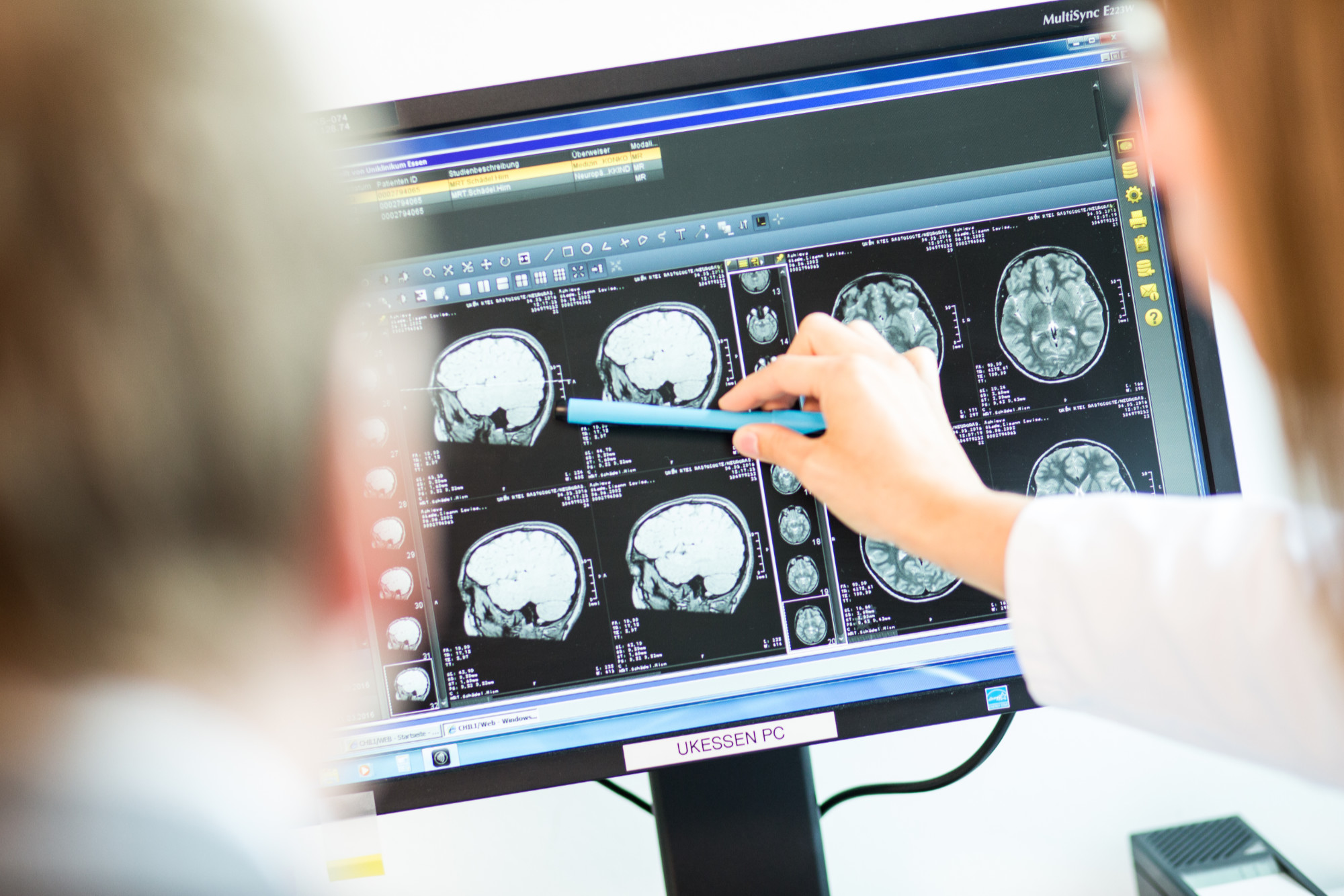 Besprechung von MRT-Bildern eines Hirntumors zur Klärung, ob Protonentherapie infrage kommt
