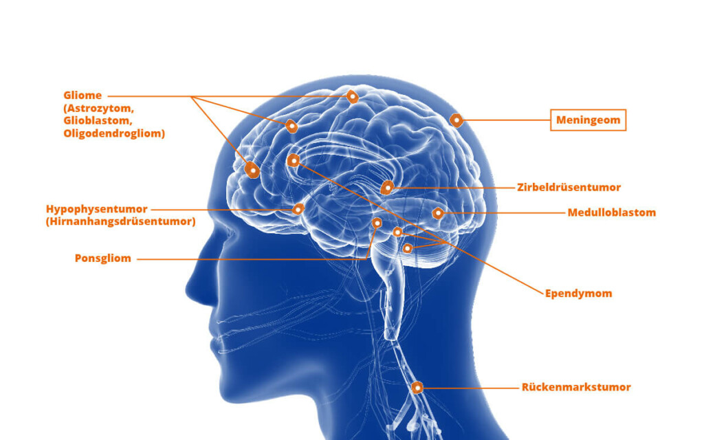 Entstehungsposition von Meningeomen im Gehirn. Meningeome entstehen nicht wie andere Hirntumoren aus der Gehirnsubstanz, sondern entwickeln sich aus den Zellen der Hirnhäute.