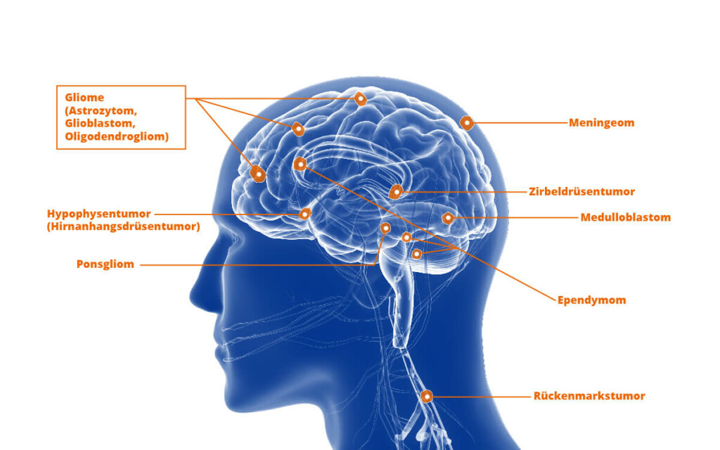 Position von Gliomen im Gehirn. Der Begriff Gliome ist ein Sammelbegriff für Tumoren des Zentralnervensystems, die der sogenannten Glia entstammen. Die Glia ist das Stützgewebe des Nervensystems.