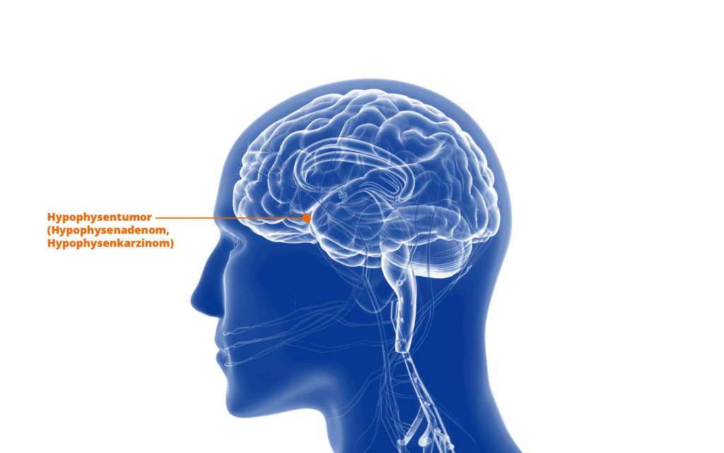 Darstellung der Lokalisation eines Hypophysentumors im menschlichen Gehirn.